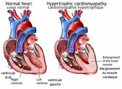 Hypertrophie cardiomyopathique féline