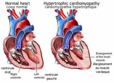 Hypertrophie cardiomyopathique féline Hypertrophie cardiomyopathique féline